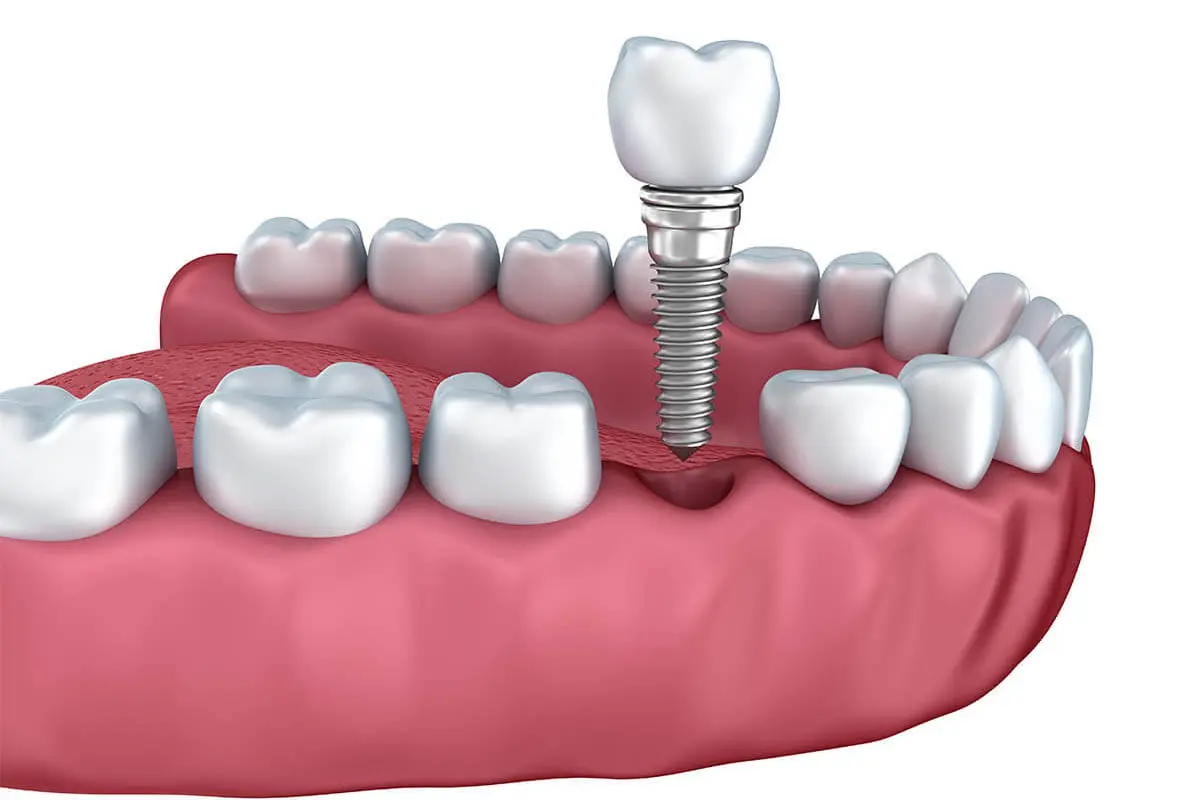 Key Facts You Should Know About Bone Grafting for Dental Implants