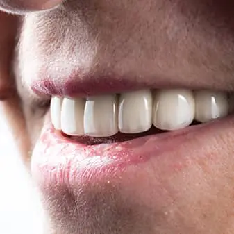 Dental Implant